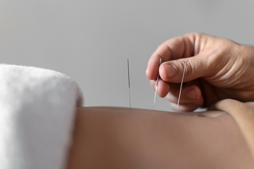 Agopuntura: benefici e applicazioni nella medicina moderna